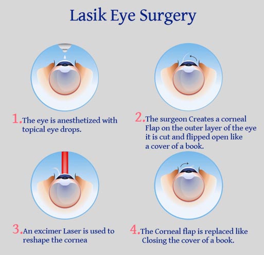 Lasik Surgery 2 