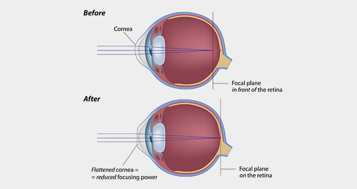 lasik